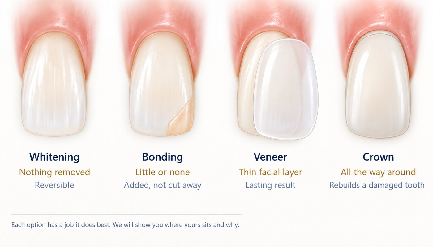Four front teeth compared: whitening, bonding, veneer and crown, with how much of the tooth each involves