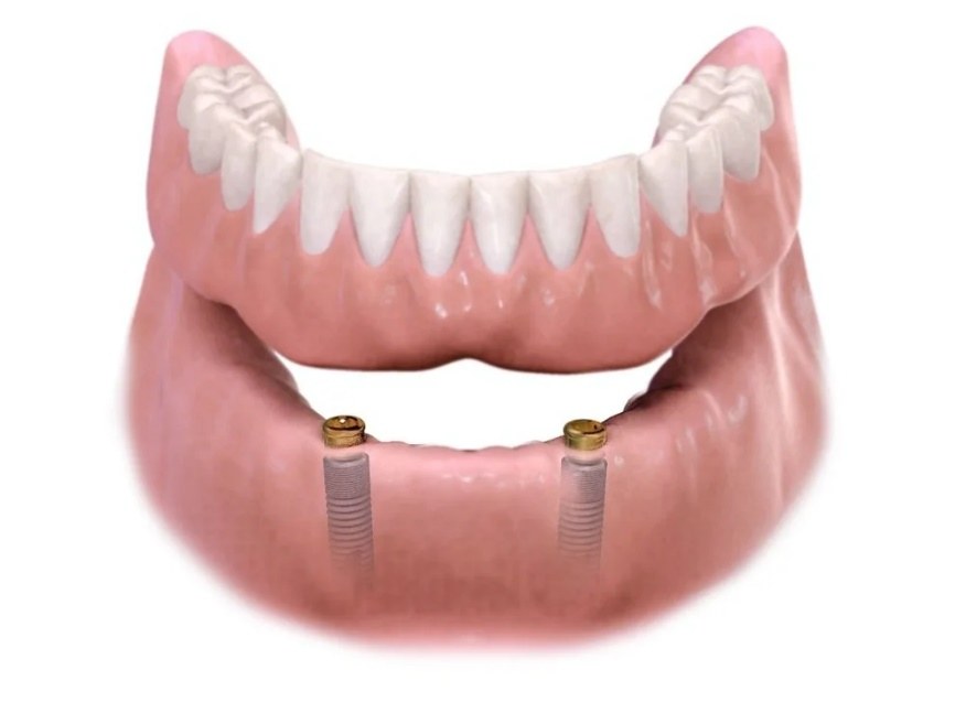 A lower denture above two implants with snap attachments