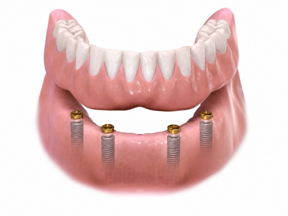 A lower denture above four implants with snap attachments
