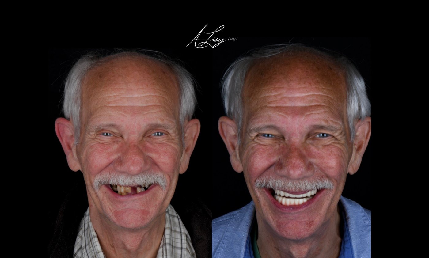 Fixed full arch implant patient, before and after: result 1 of 3
