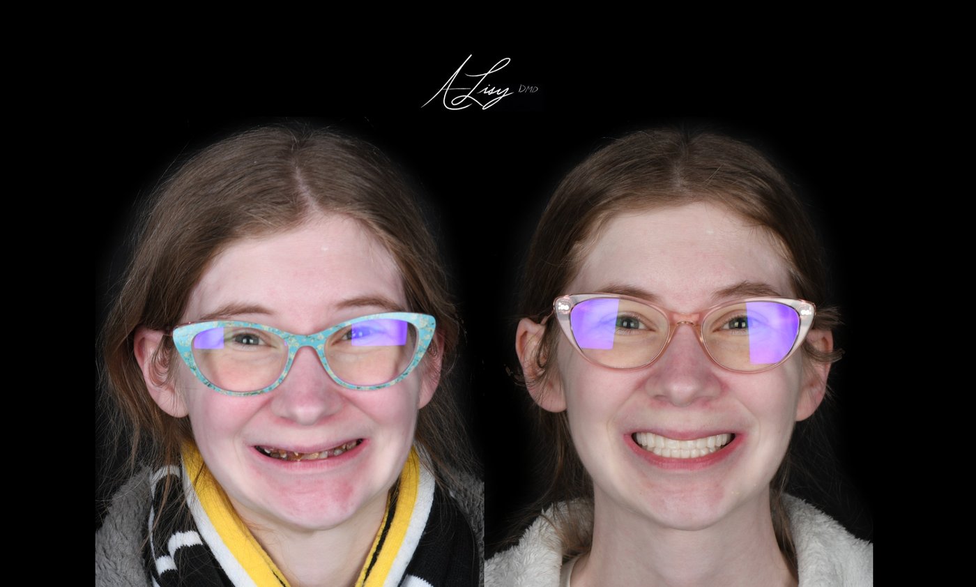 Fixed full arch implant patient, before and after: result 2 of 3