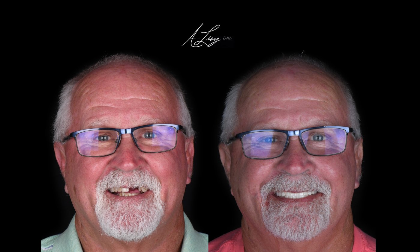 Fixed full arch implant patient, before and after: result 3 of 3